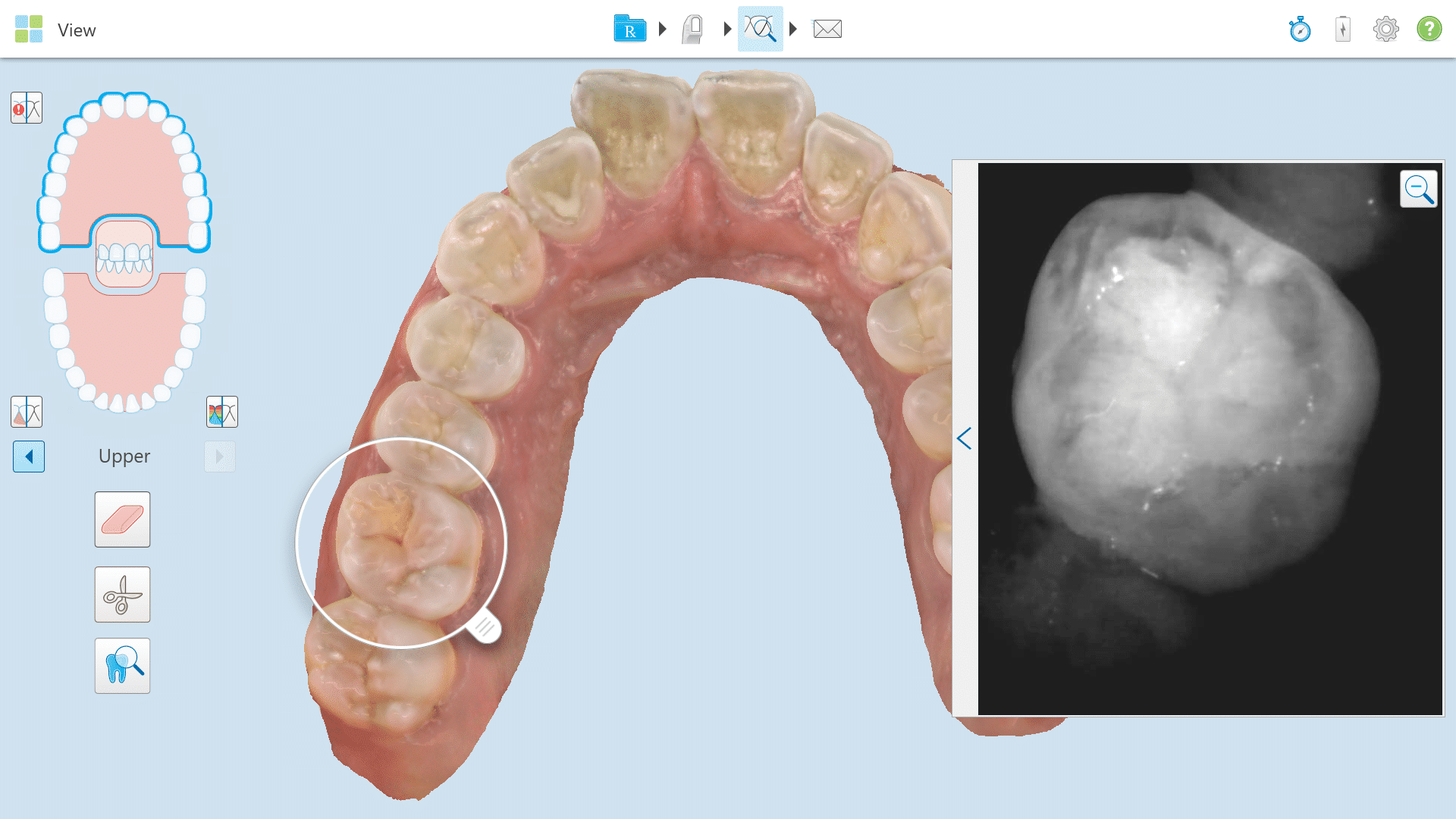 iTero Digital Impressions Allen Orthodontist in Allen, TX